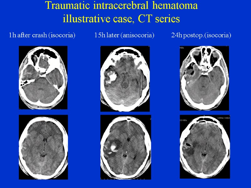 Traumatic intracerebral hematoma illustrative case, CT series 1h after crash (isocoria)   